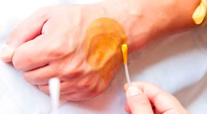 лечение йодом