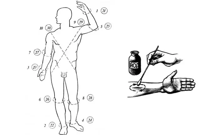 схема нанесения йодовых кругов