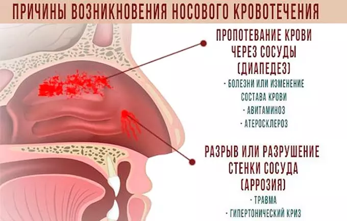причины носового кровотечения