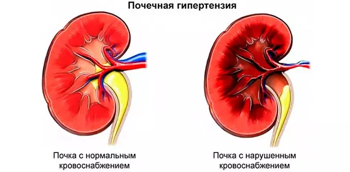 почечная гипертензия
