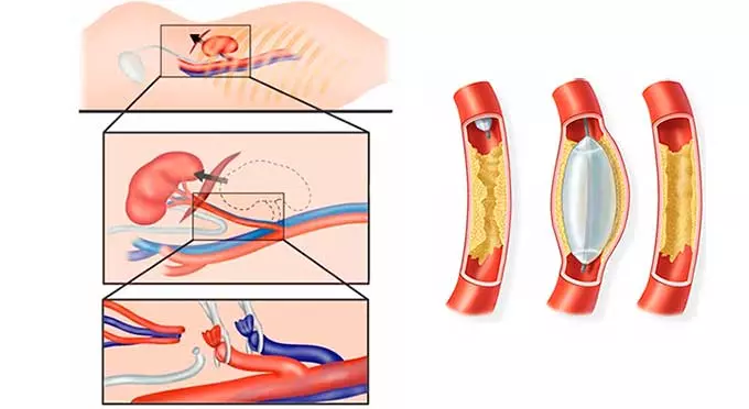операции на почках