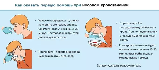 первая помощь при носовом кровотечении