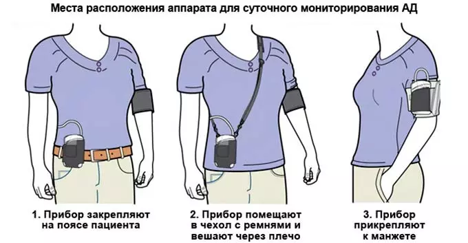 расположение тонометра при СМАД