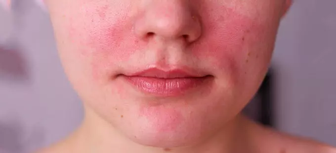 Побочные действия лекарства аллергия на лице