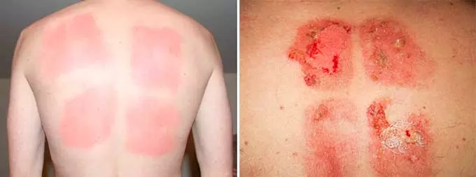 раздражение кожи от горчичника