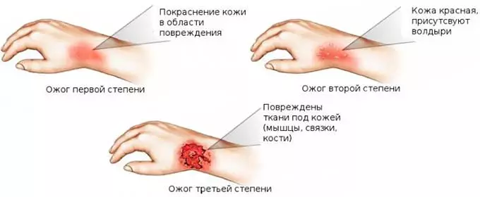 степени ожога