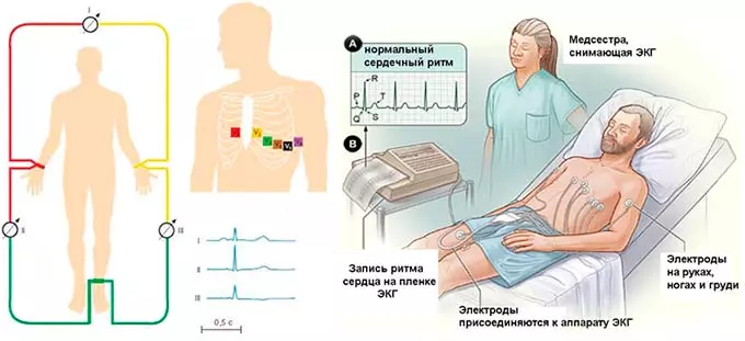 установка датчиков при экг