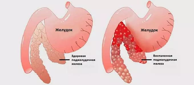 воспаление поджелудочной