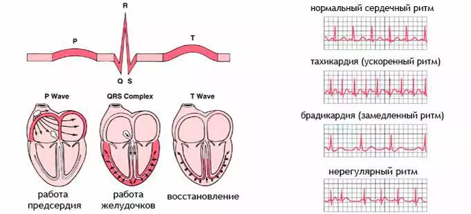 сердечные болезни на экг