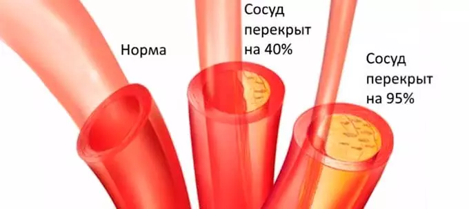 Состояние сосудов при повышенном АД суженные сосуды