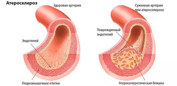 Атеросклероз