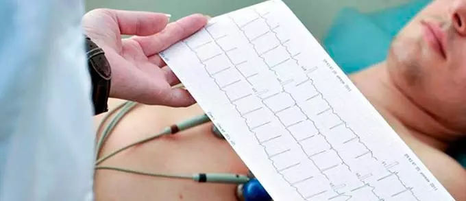 расшифровка экг