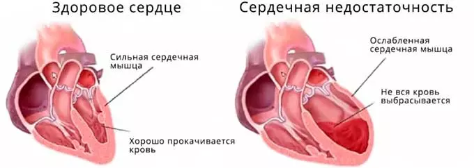 Воздействие кальяна на сердечно-сосудистую систему сердечная недостаточность