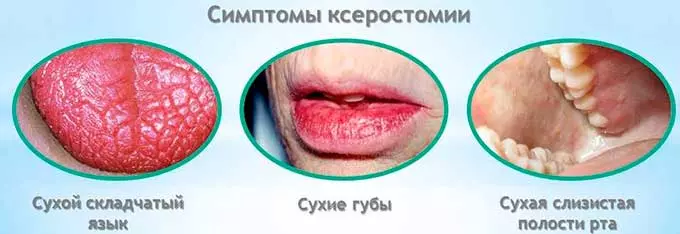 симптомы ксеротомии