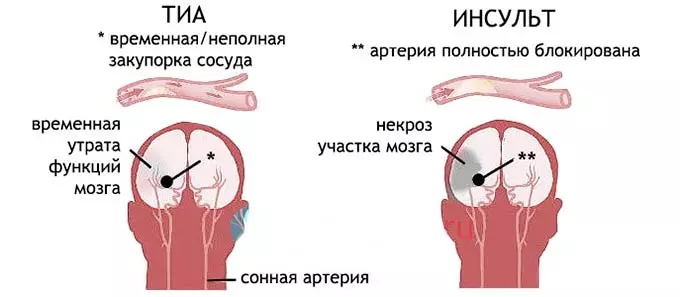 Последствия для организма при сужении и закупорке сосудов последствия закупорки сосудов