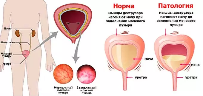 частое мочеиспускание
