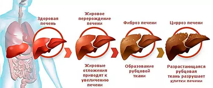 поражение тканей печени
