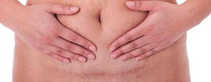 Кесарево сечение шрам от кесарева сечения