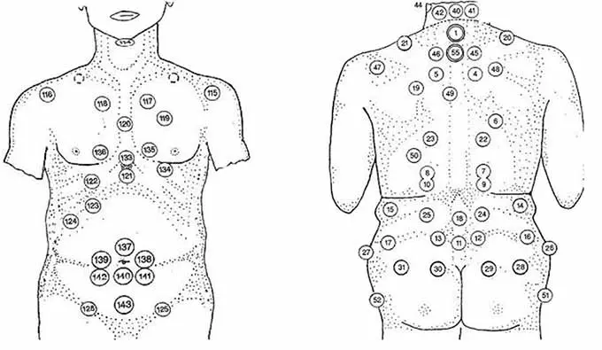 точки хиджамы