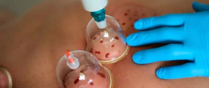 кровопускание