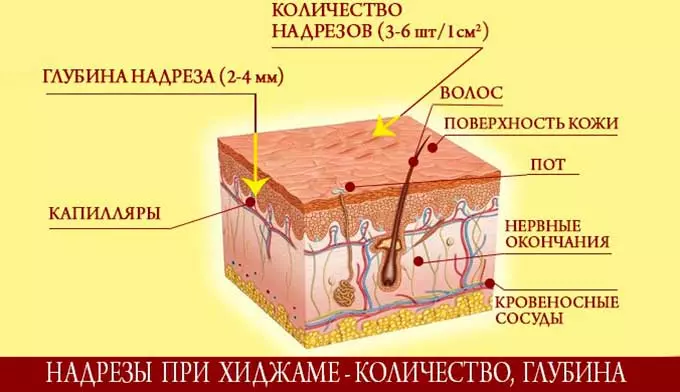 разрез при хиджаме