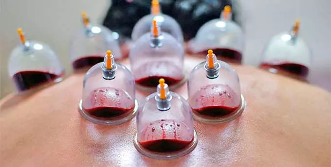 кровопускание с банками