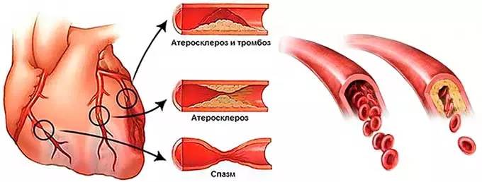Какое давление считается нормальным для мужчин пожилой группы сужение просвета сосудов