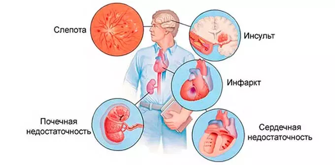 осложнения гипертонии