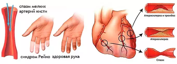 Поражение сосудов