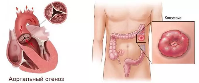 Колостома и аортальный стеноз