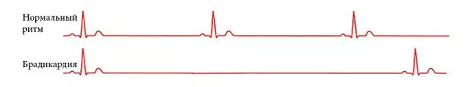 Проявление брадикардии