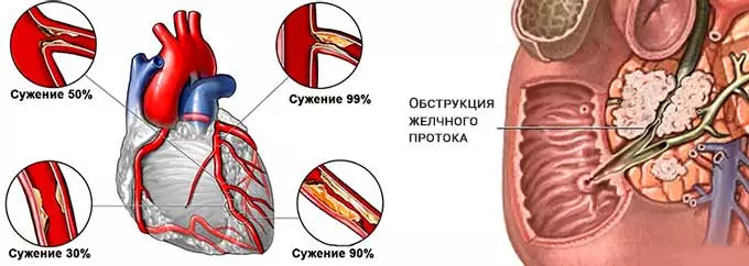 Ишемия и обструкция желчного протока