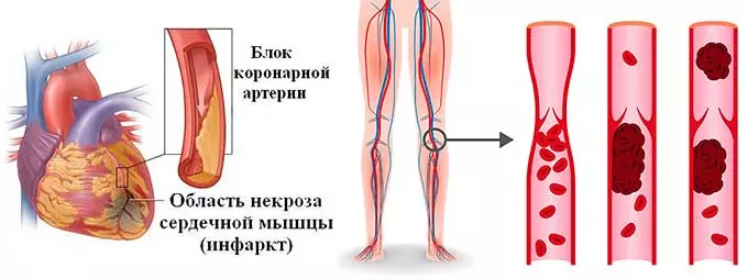 Нарушение кровообращения в сосудах