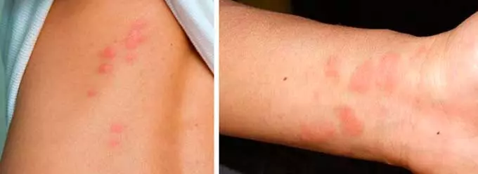 Проявление аллергической реакции на коже