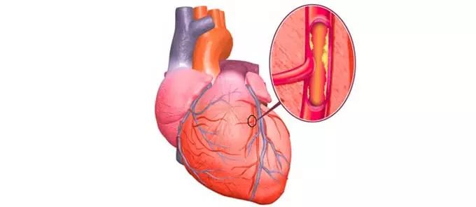 Сердечная ишемия