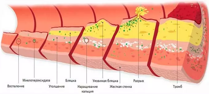 Поражение стенок сосудов