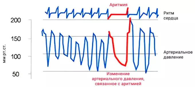 Изменение давления связанное с аритмией