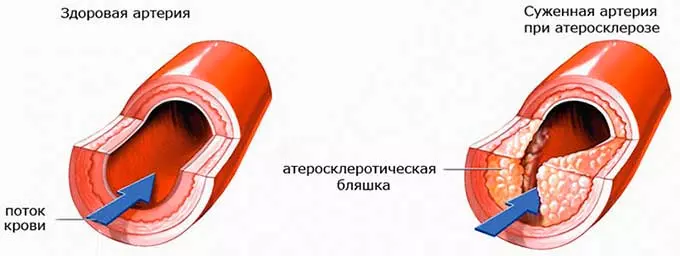 Артерии при атеросклерозе
