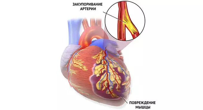 Закупорка артерии сердца