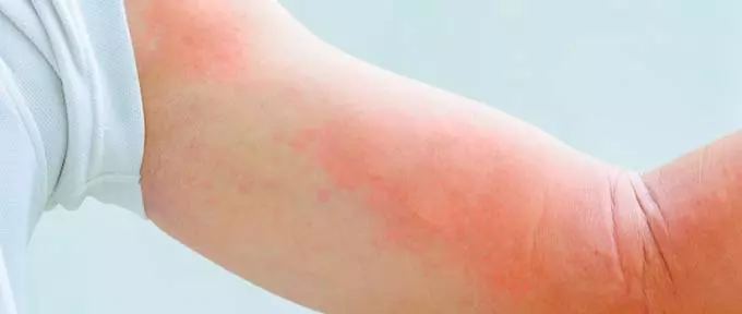 Побочные эффекты Кожная сыпь на теле