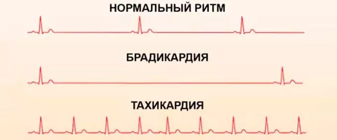 Нарушения сердечного ритма