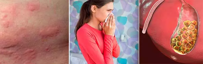 Проявление аллергии