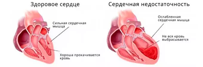 Сердечная недостаточность
