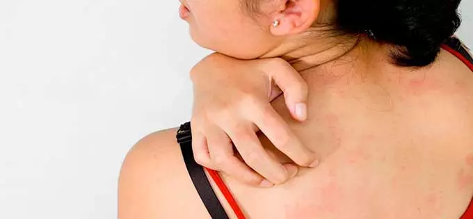 Кожный зуд и аллергия