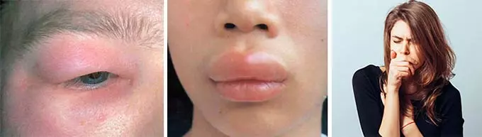 Отечность и чихание