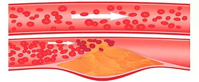 Холестериновая бляшка на сосуде