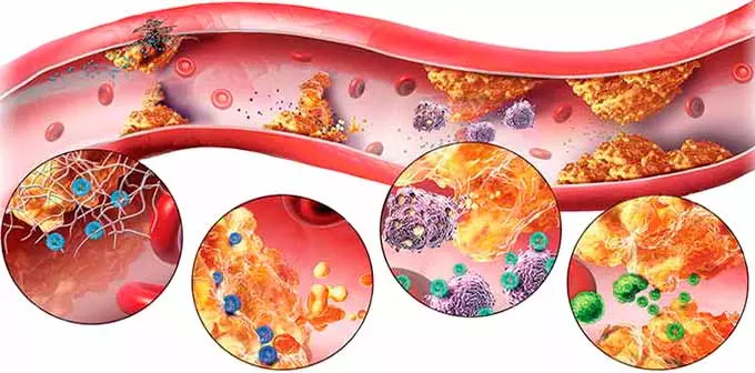 Зашлакованные сосуды