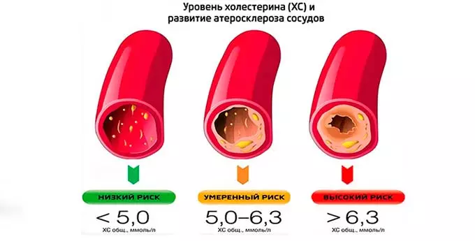 Накопление холестерина в сосудах