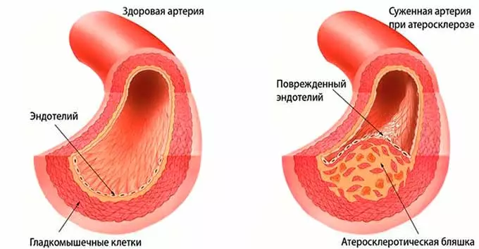 Сужение сосудистого просвета