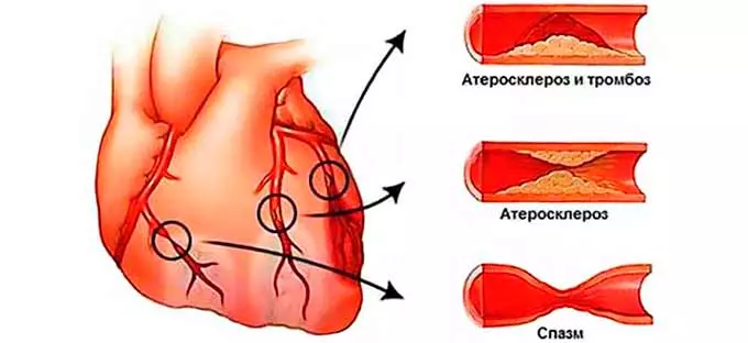 Могут ли быть осложнения при показателе 140/60 и ниже Поражение и закупорка сосудов сердца